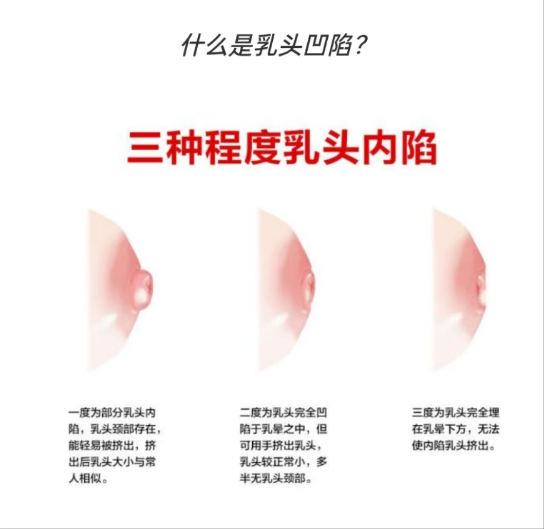 乳頭凹陷的媽媽該如何哺乳？